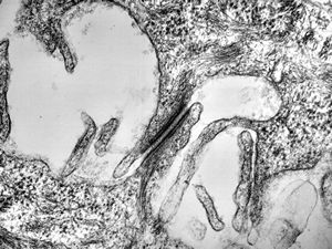 F,23y. | desmosome - normal oral mucosa